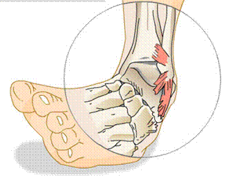 lateral-ankle-sprain-mechanism