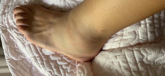 swollen-ankle
